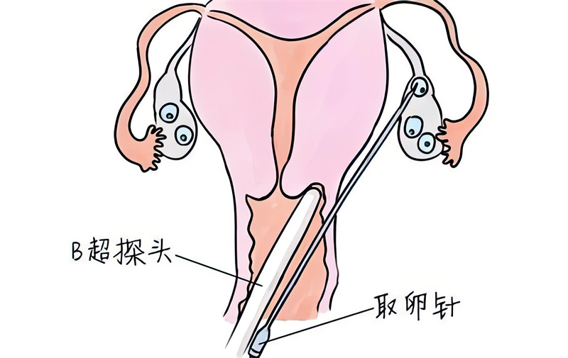 试管婴儿取卵